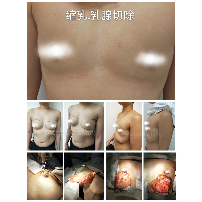 切除乳腺缩乳-1.1